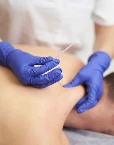 dry needling for C-Section